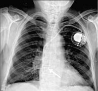 Pacemaker